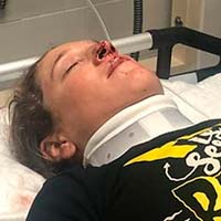 Noga Korem se lesiona de gravedad con una barrera metálica en un sendero de La Palma