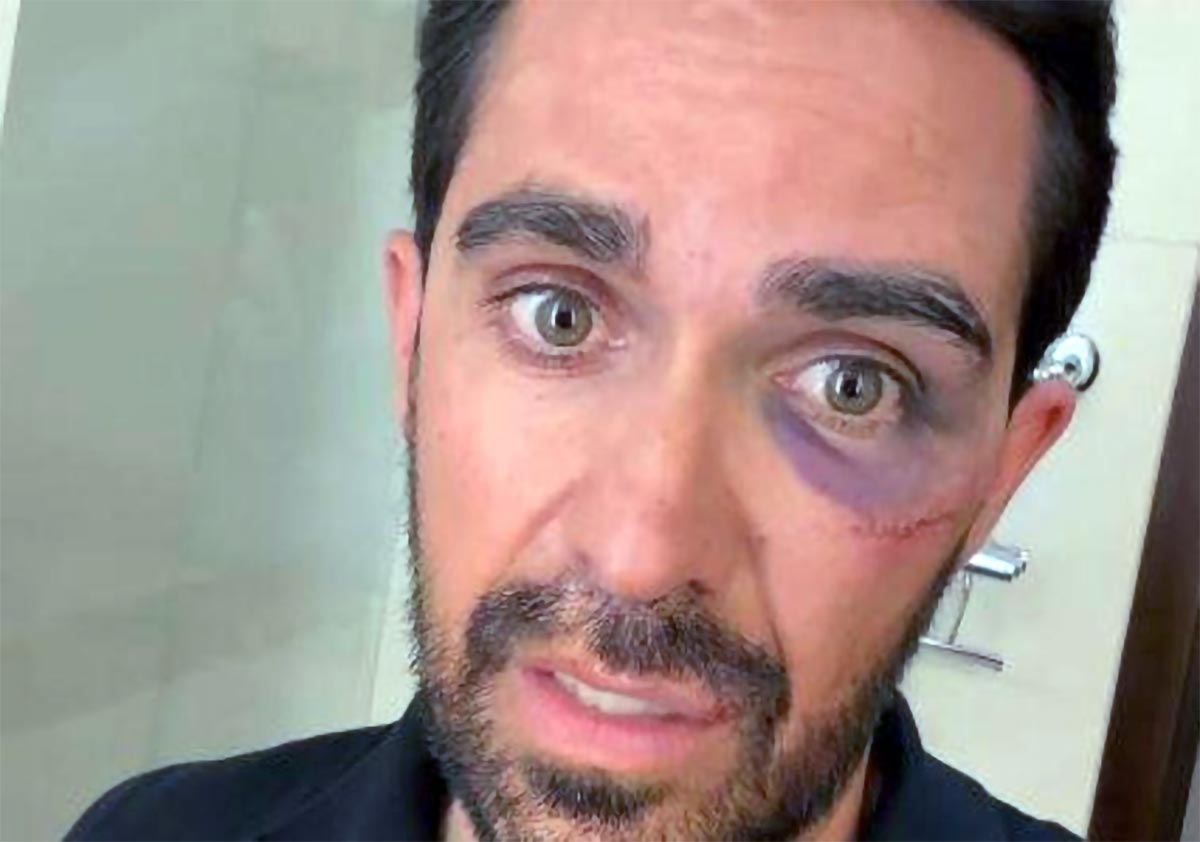 Alberto Contador sufre una caída en el Desafío China by La Vuelta y termina con puntos de sutura en ceja, pómulo y labio